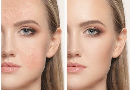 Acne treatment at Mandarin spa Nijmegen Uden